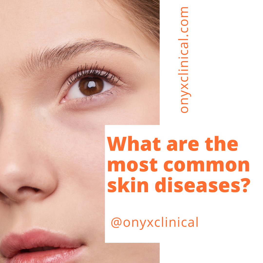 You are currently viewing What are the most common Skin Diseases?