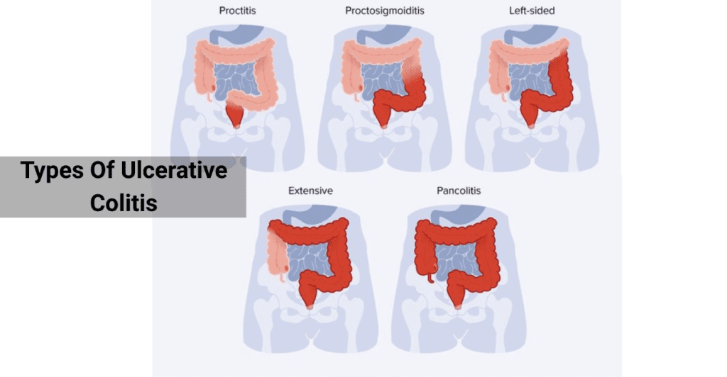 Ulcerative Colitis Treatment Options