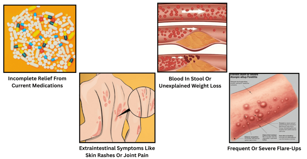 Ulcerative Colitis Treatment Options